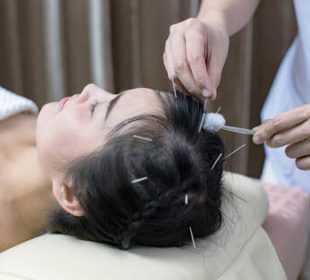 Acupuncture for Hair Growth