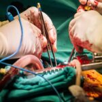 Benefits of Gastric Bypass Surgery